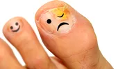 Ciuperca unghiei – cele mai bune tratamente. Semne că unghia e infectată cu o ciupercă