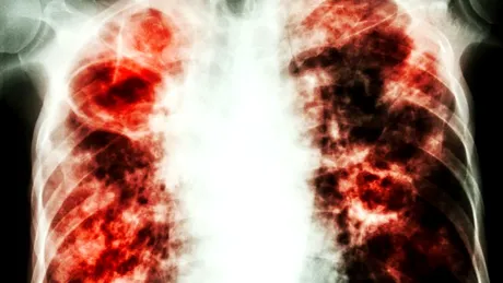 #RespirăSperanţă, prima campanie de informare despre fibroza pulmonară idiopatică (FPI)