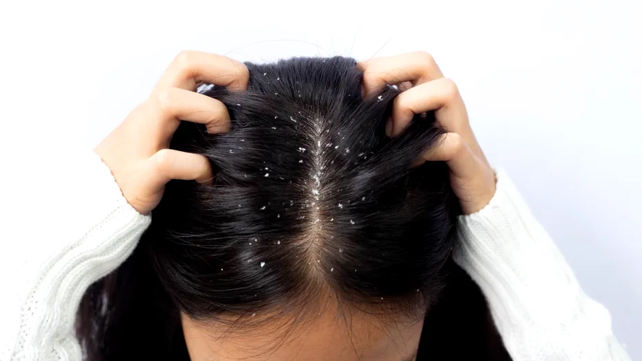 Cum poți scăpa de mătreață în mod natural. Obiceiurile care pot reduce exfolierea scalpului și preveni reapariția ei