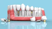 Implantul dentar pe etape, de la prima vizită până la ritualul postoperator