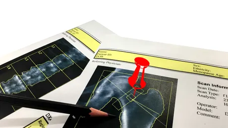 Cum pot fi prevenite fracturile la vârsta a treia?