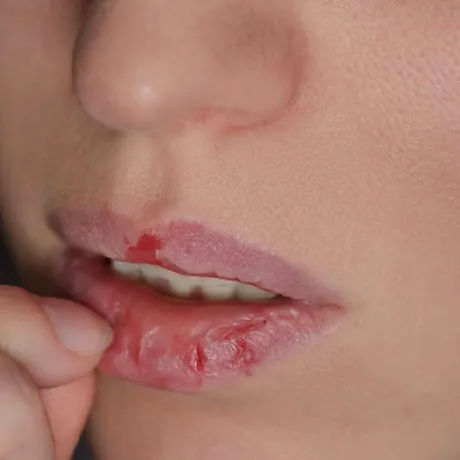 De ce ne crapă buzele toamna și iarna și ce ingrediente ajută la repararea lor