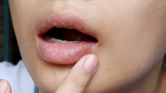 Buze uscate și crăpate? Remediul de casă care le salvează instant