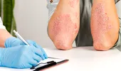 Cele mai întâlnite afecțiuni dermatologice. Bărbații, predispuși la psoriazis și infecții cu transmitere sexuală