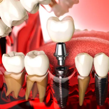 Ce trebuie să știe pacientul care a pierdut mai mulți dinți și are nevoie de tratament cu implanturi dentare și adiție de os