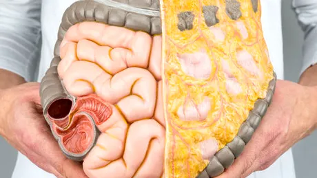 Boala Crohn: simptome, diagnostic, tratament