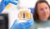 (P) Cum afecteaza diabetul succesul implanturilor dentare