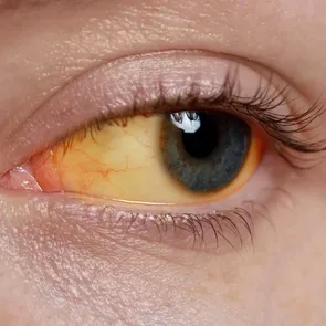 Ce îți spune „mucusul ocular” despre sănătatea ochilor: culorile care indică un semnal de alarmă
