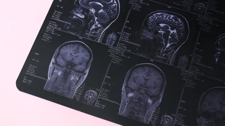 Diagnosticul greșit primit de un adolescent: Adevărul crunt din spatele unor migrene și atacuri de panică