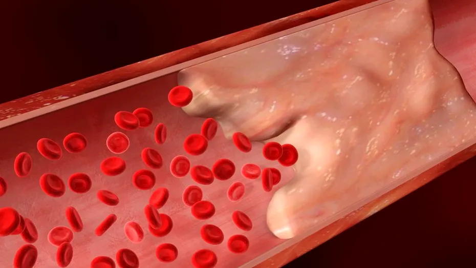 Hipertensiunea arterială creşte riscul de a dezvolta COVID-19 în forme severe