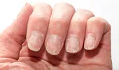 Unghiile pot semnala boli grave. Semnul discret care poate indica probleme ale inimii, ficatului sau rinichilor