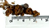 Pietre la rinichi (calculi renali): cum să le elimini fără pastile și fără să te doară