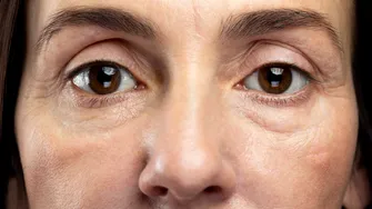 De ce părem obosiți și îmbătrâniți chiar dacă dormim suficient. Pielea din jurul ochilor, cea care ne trădează!