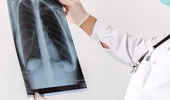 Studiu UMF Iaşi: „Explorăm dacă algoritmii de inteligenţă artificială reuşesc să identifice particularităţi ale bolii COVID-19 pe radiografia pulmonară standard”