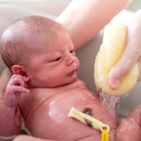 Clamparea întârziată a cordonului ombilical reduce cu 50% riscul de deces în rândul bebelușilor născuți prematur