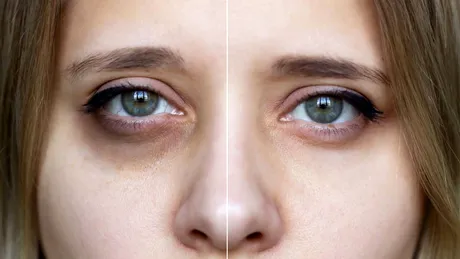 Ce înseamnă Ferritin Face, termenul devenit viral pe TikTok? Are legătură cu deficitul de fier!