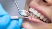 Avantajele şi dezavantajele faţetelor dentare