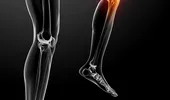 Conf. Dr. Daniel Grigorie: “Osteoporoza este boala oaselor care poate fi ţinută sub control!”