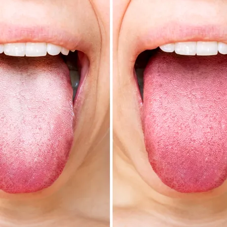 Ce înseamnă dacă limba îți devine verde, albastră, portocalie, neagră sau gri