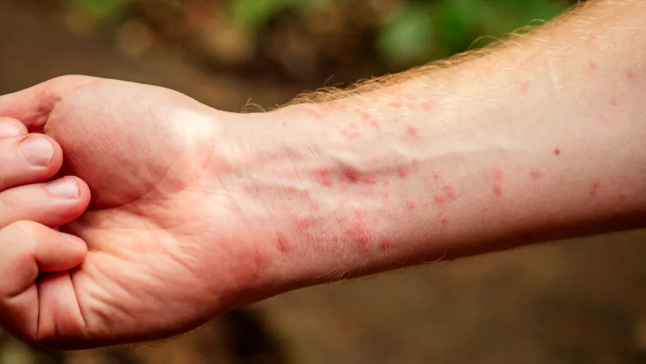 Mușcătura de țânțar: dacă ți se întâmplă ASTA înseamnă că ai luat un virus