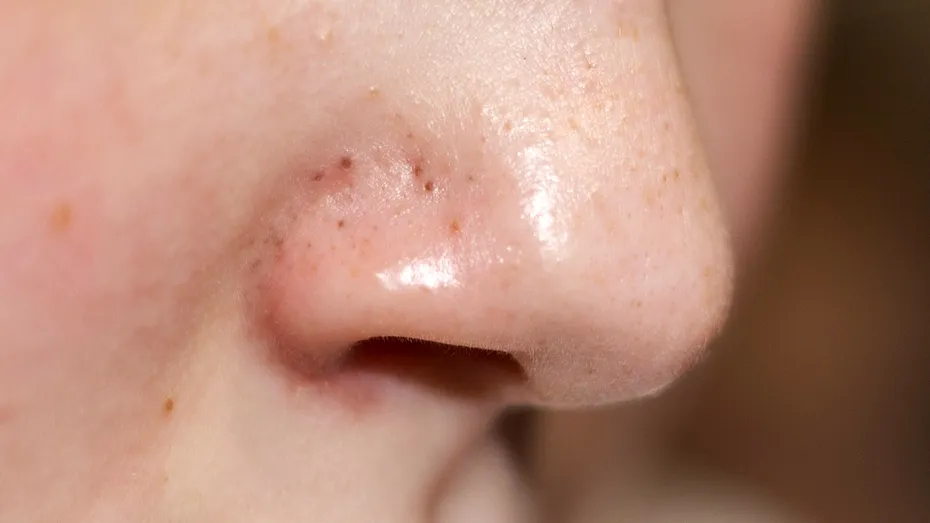 Tratamentul natural de 7 lei împotriva punctelor negre. Scapi de imperfecțiuni cu acest exfoliant preparat acasă