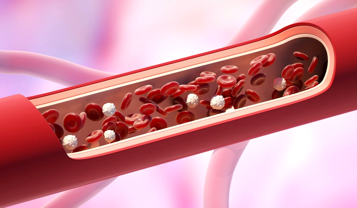 Colesterol mărit (Hipercolesterolemia): cauze, semne și simptome, alimente interzise