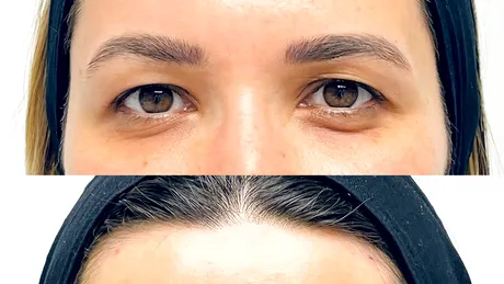 Lifting de sprâncene, un nou trend printre vedete. Vezi cât costă