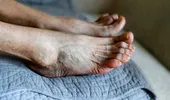 Picioarele crăpate îți pot pune viața în pericol! Află ce semn ascund acestea despre sănătatea ta