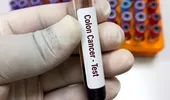 Testul de sânge gratuit care ajută la descoperirea cancerului de colon în stadiu incipient