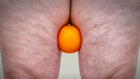Cele mai eficiente tratamente anticelulită. Cum atenuezi aspectul de coajă de portocală