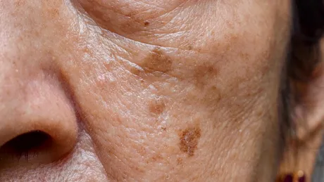 20 de semne care apar pe piele când ai ficatul bolnav