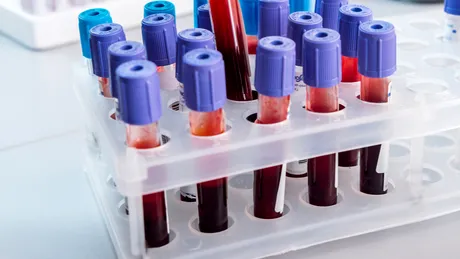 Ce analize de sânge sunt recomandate primăvara?