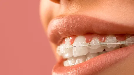Porţi aparat dentar? Cum să îl îngrijeşti în perioada de izolare