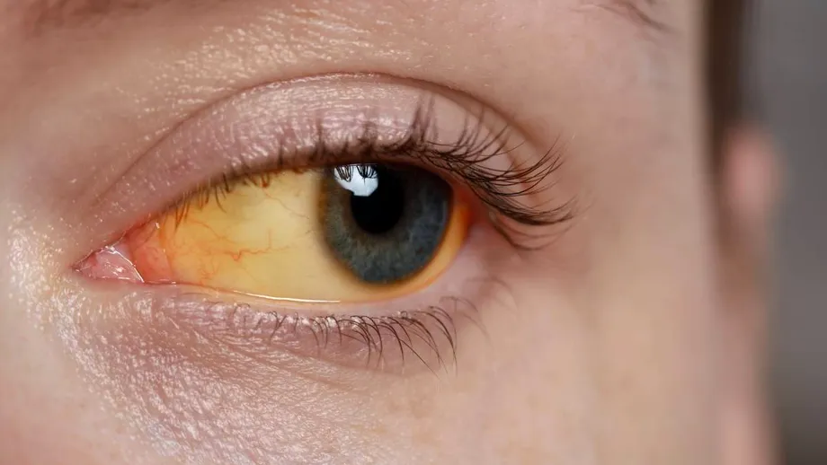 Ce îți spune „mucusul ocular” despre sănătatea ochilor: culorile care indică un semnal de alarmă