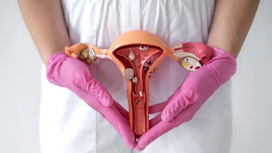 Suferi de endometrioză? Aceste alimente îți pot accentua simptomele!