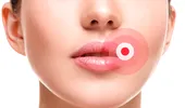 Cum să scapi rapid de herpes, urmând sfaturile medicilor dermatologi