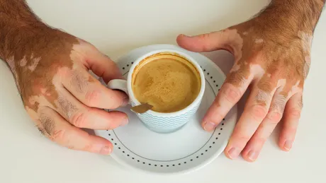 STUDIU: Speranță pentru 70 de milioane de oameni care suferă de o boală de piele stigmatizantă. Cum ar putea fi tratat vitiligo cu celule stem recoltate la naștere