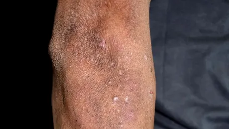 Lichen spinulosum: cauze, simptome, tratament adjuvant