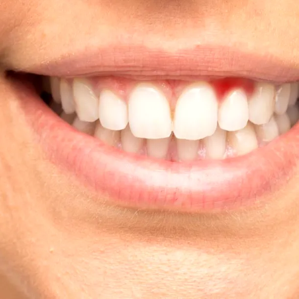 Ce carențe ai dacă îți sângerează gingiile sau îți apar afte