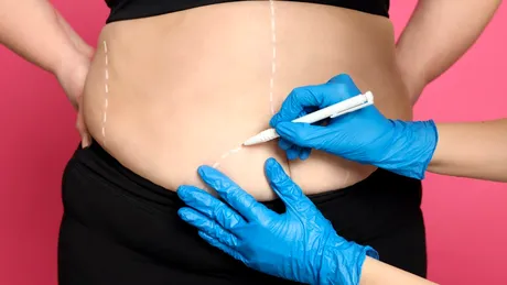 Prima vară după chirurgia bariatrică: cum îți schimbi corpul, dar și relația cu tine însuți