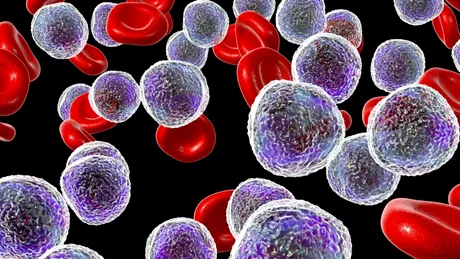 Mielodisplazia: cauze, simptome, tratament