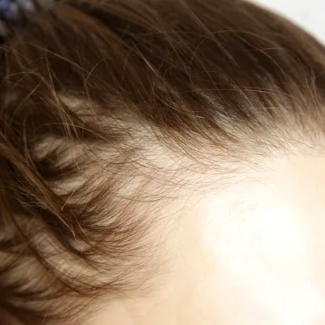 Slăbești, dar îți cade părul? Ce legătură au injecțiile pentru slăbit cu alopecia