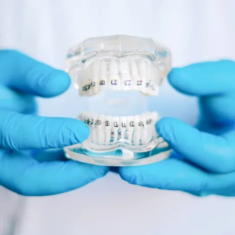 Cum influențează tipul bracketului puterea de aderență pe dinte — ce înseamnă pentru tratamentul tău ortodontic