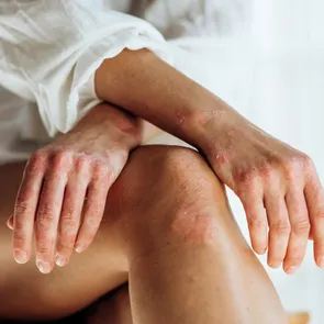 Remediu naturist împotriva psoriazisului: calmare și hidratare profundă cu ingrediente naturale