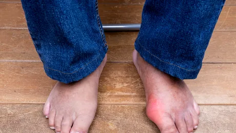 Dieta pentru gută: meniu pe 7 zile. Ce să mănânci să reduci acidul uric în exces