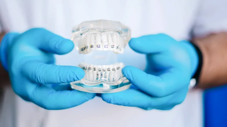 Cum influențează tipul bracketului puterea de aderență pe dinte — ce înseamnă pentru tratamentul tău ortodontic