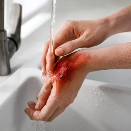 (P) Cea mai bună cremă pentru arsuri și cicatrici: ce trebuie să conțină și ce recomandă specialiștii