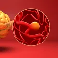 (P) Anevrismul cerebral: tratament minim invaziv prin neuroradiologie intervențională
