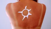 6 remedii împotriva arsurilor solare care funcționează mai bine decât aloe vera