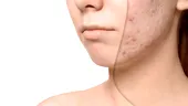 De ce apar petele pigmentare mai repede vara. Remedii naturale care uniformizează tenul
